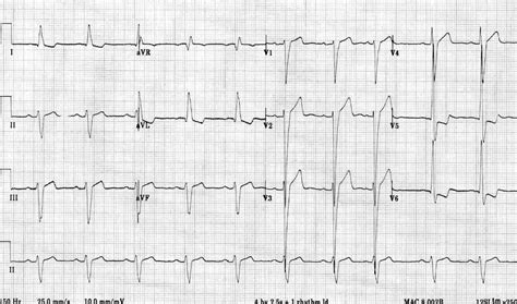 ecg lv hypertrophy|what is lvh on ecg.